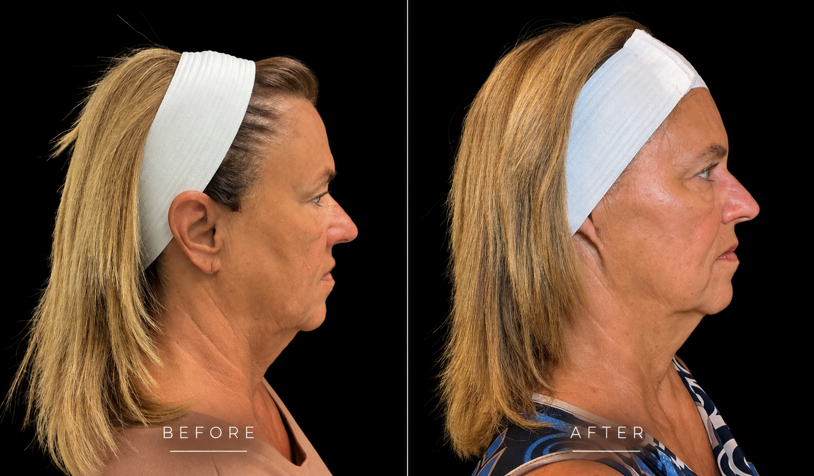Morpheus8 before and after, profile view