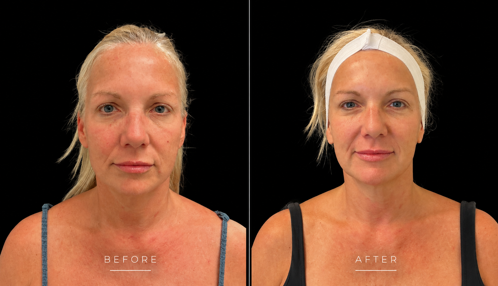 Morpheus8 before and after, front view