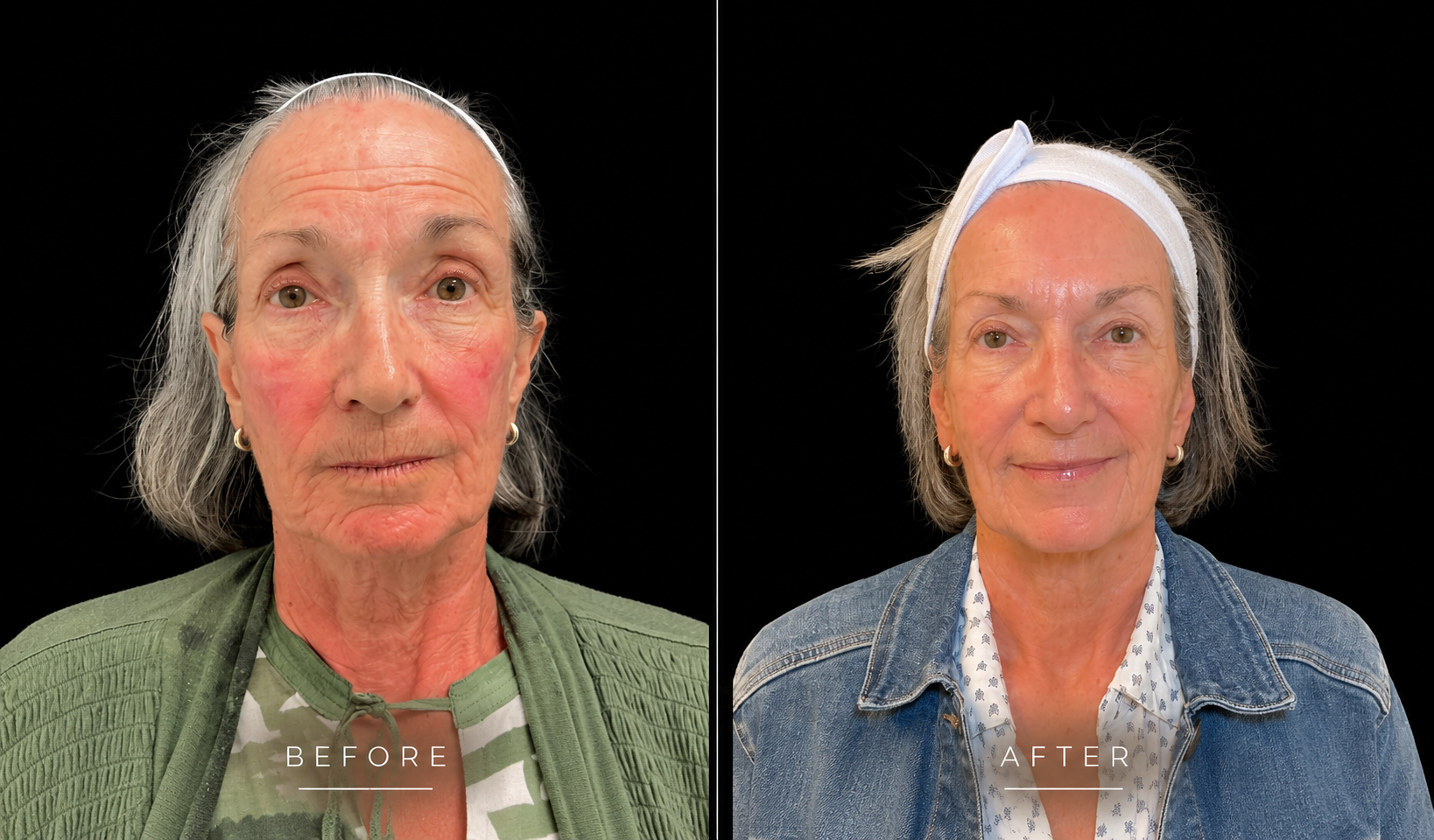 Morpheus8 before and after, front view