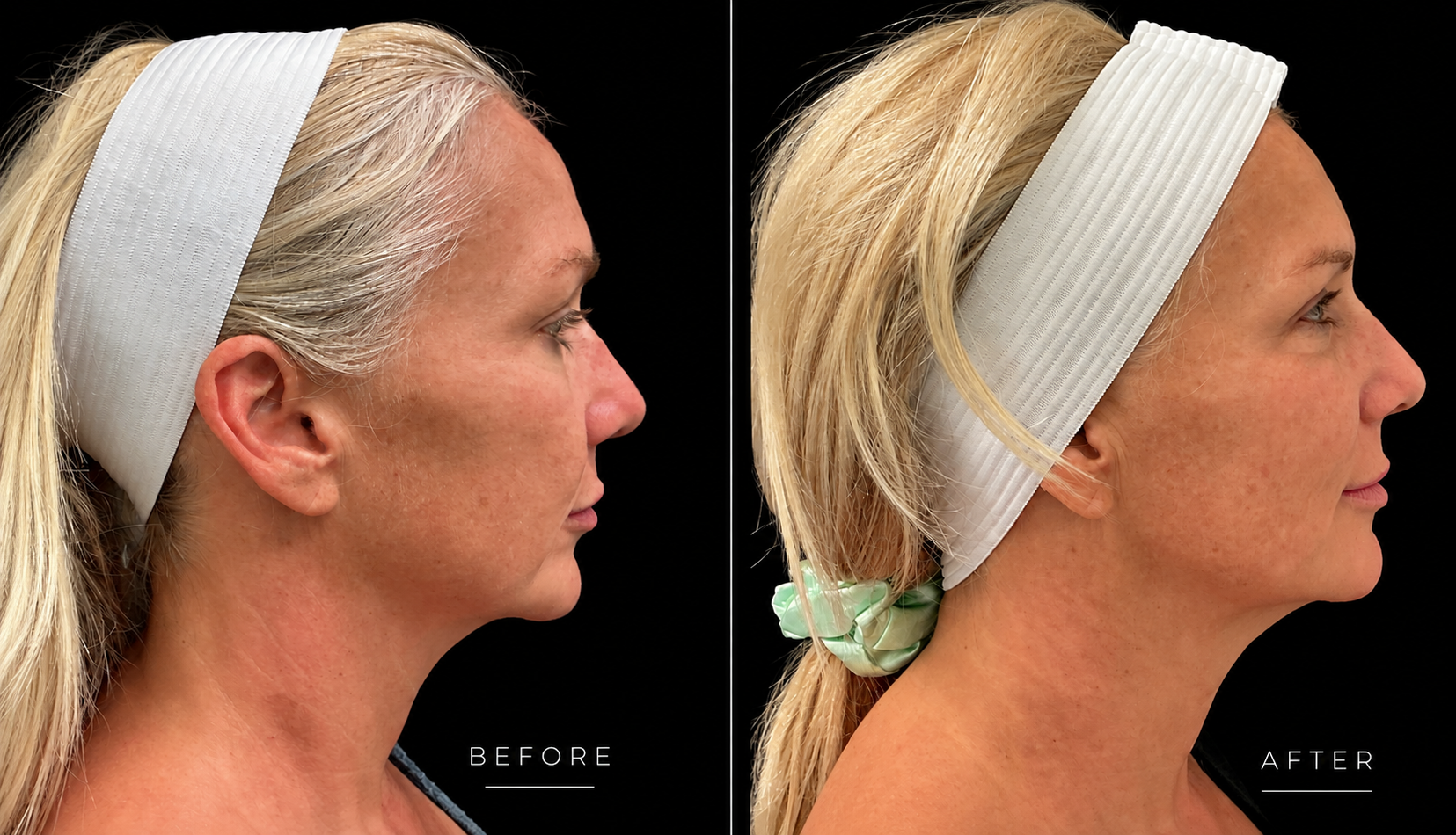 Morpheus8 before and after, profile view