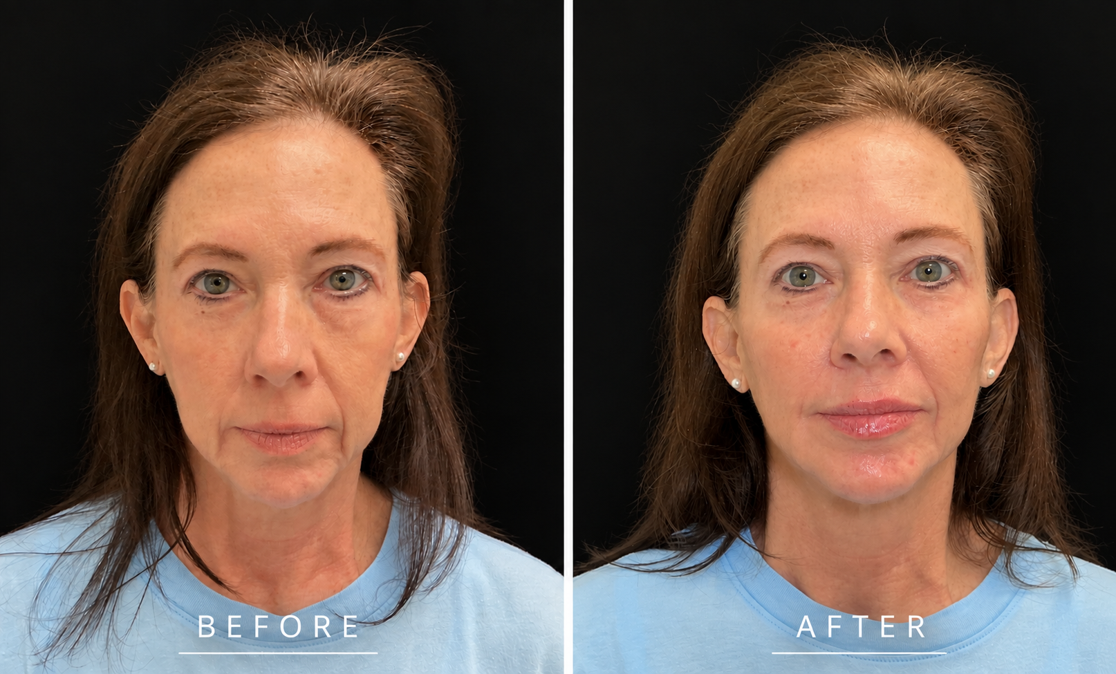 Dermal filler before and after, front view