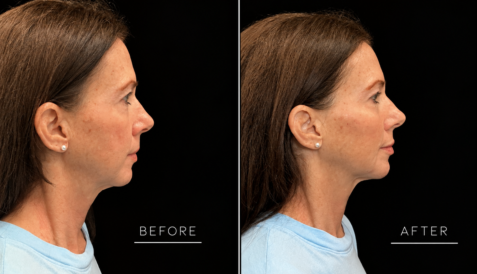 Dermal filler before and after, profile view
